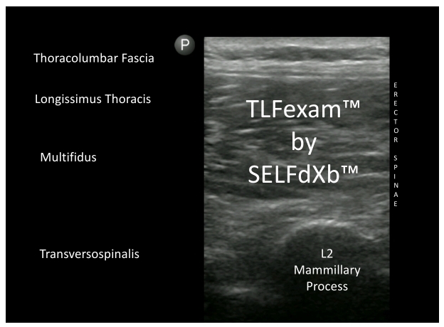 SELFdXb_TLFexam.Erector_Spinae_Ad_C2023